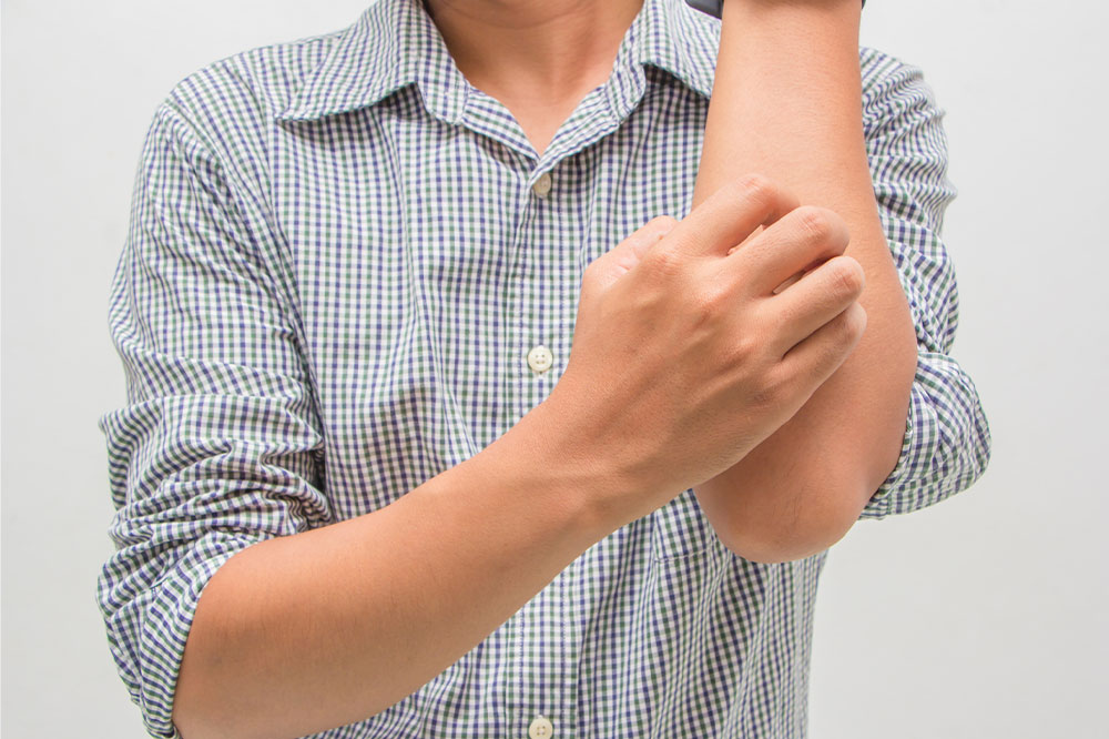 Eczema – Signs, Symptoms, and Home Remedies